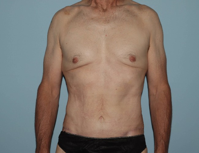 Male Abdominoplasty with Skin Tightening Before After Photos - Front Side View After Photo 5702