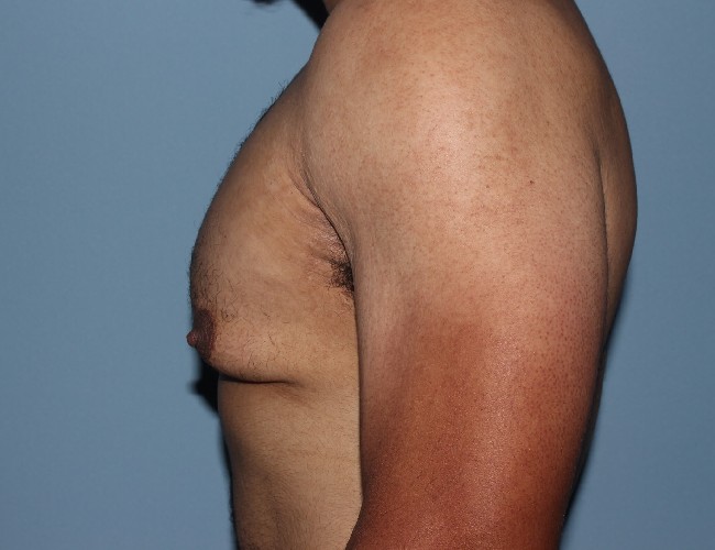 Minimal incision Gynecomastia Treatment Before and After - Left Side View Before Photo 5712