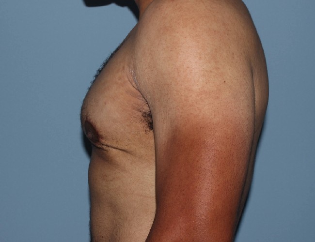 Minimal incision Gynecomastia Treatment Before and After - Left Side View After Photo 5712
