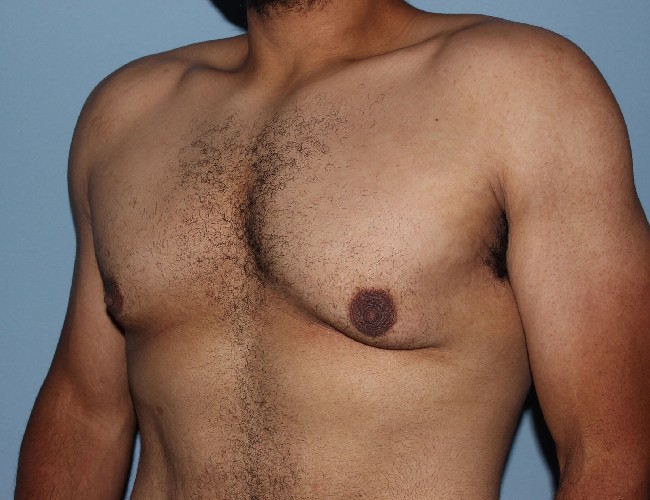 Minimal incision Gynecomastia Treatment Before and After - Left Side 45 degree View Before Photo 5712