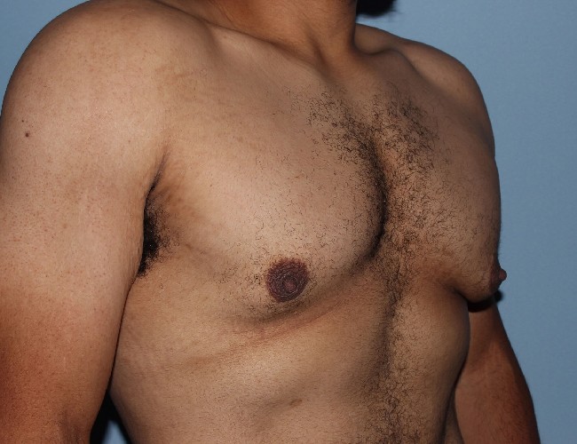 Minimal incision Gynecomastia Treatment Before and After - Right Side 45 degree View Before Photo 5712