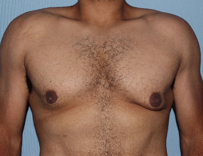 Minimal incision Gynecomastia Treatment Before and After - Front Side View Before Photo 5712
