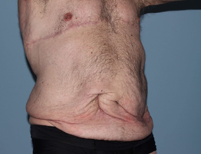 After Weight Loss Male Plastic Surgery Before and After - Right Side 45 degree View Before Photo 5721