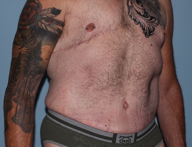 After Weight Loss Male Plastic Surgery Before and After - Right Side 45 degree View After Photo 5721