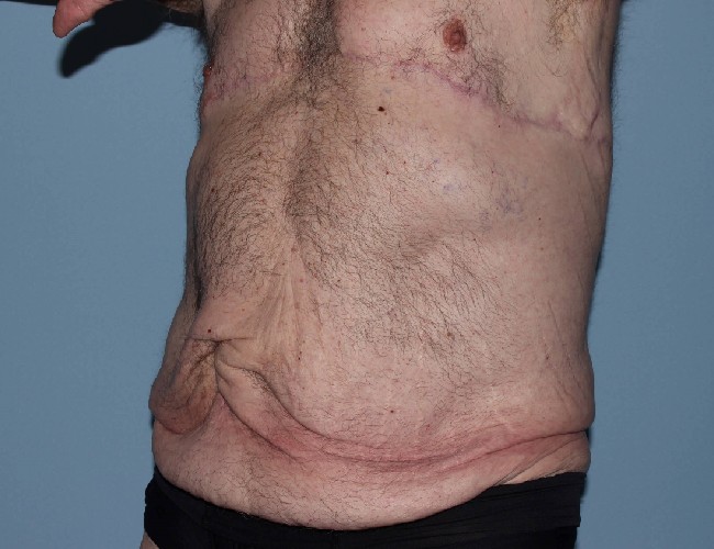 After Weight Loss Male Plastic Surgery Before and After - Left Side 45 degree View Before Photo 5721