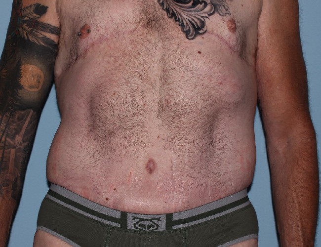 After Weight Loss Male Plastic Surgery Before and After - Front Side View After Photo 5721