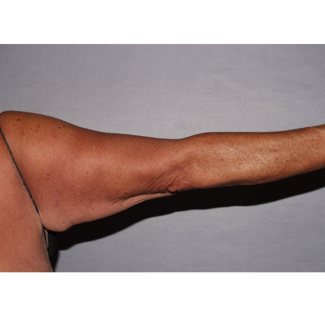 image before arm lift after 130 pound weight loss - arm sideward case 6546