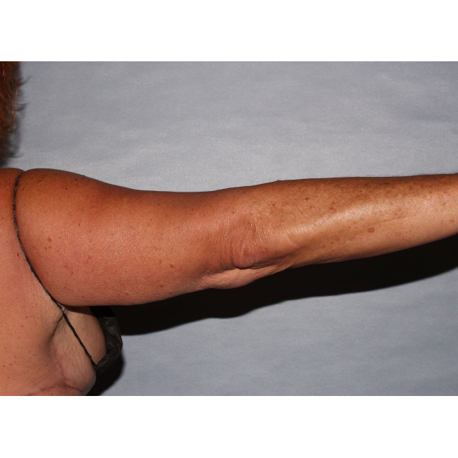 image after arm lift after 130 pound weight loss - arm sideward case 6546