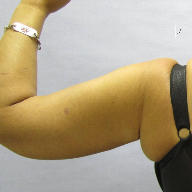 image after arm lift - batwing deformity correction case 6556