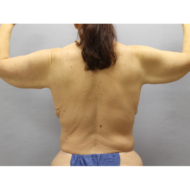 image before arm lift after weight loss - back view case 6559