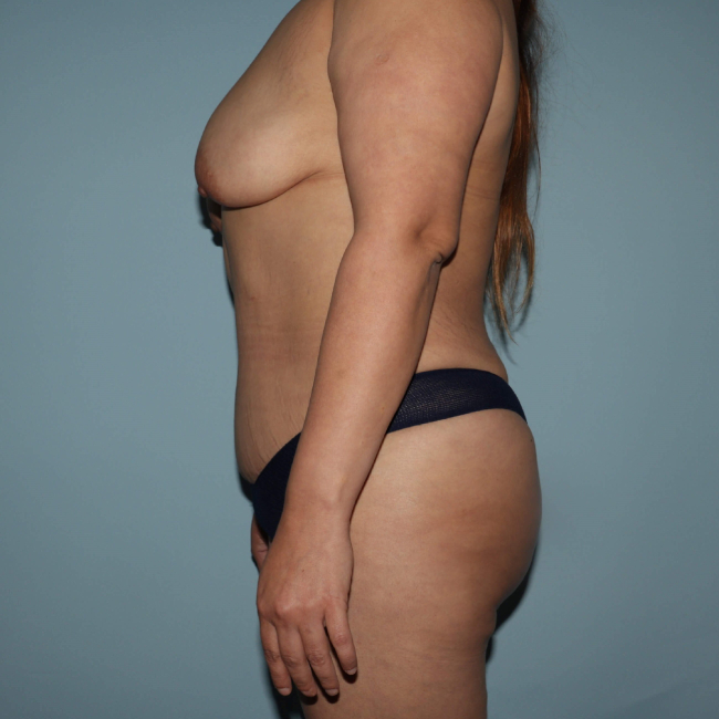 After Arm lift Before and After Photo Left Side View Case 6564