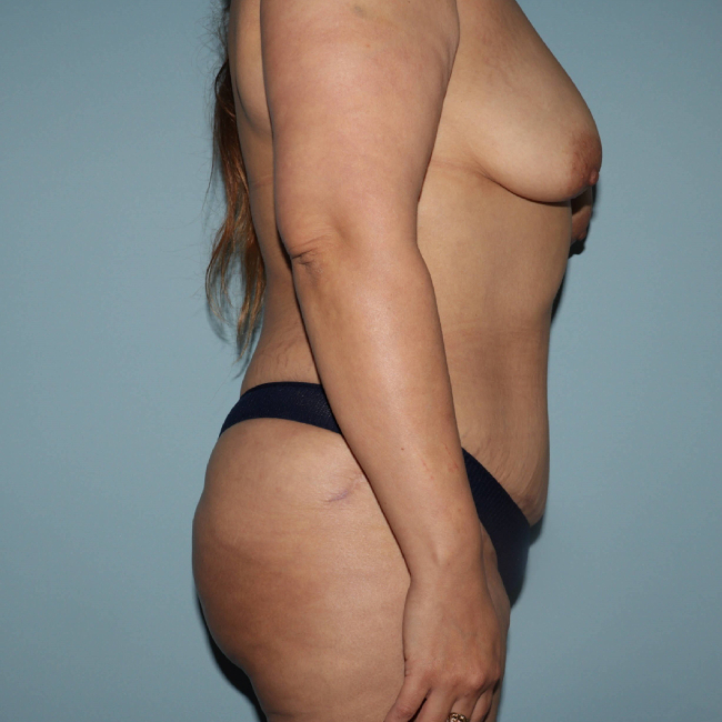 After Arm lift Before and After Photo Right Side View Case 6564