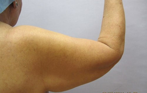 image before arm lift - arm flab back view case 6575