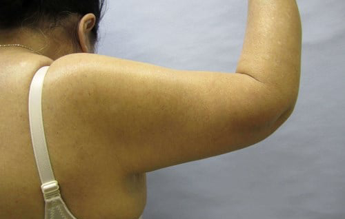 image after arm lift - arm flab back view case 6575