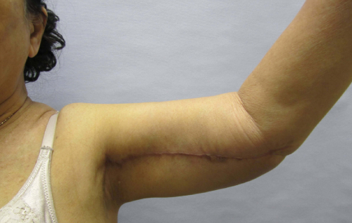 image after arm lift - arm flab front view case 6575