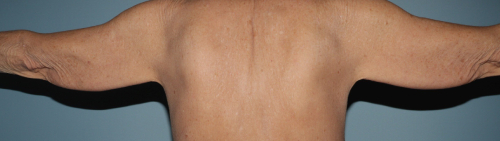 image before arm lift - brachioplasty back view case 6593