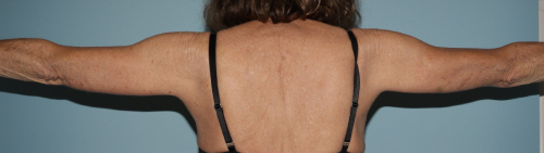 image after arm lift - brachioplasty back view case 6593
