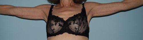 image after arm lift - brachioplasty front view case 6593