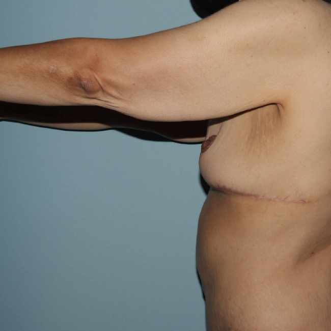 image before arm lift after weight loss - extended brachioplasty left arm view case 6600