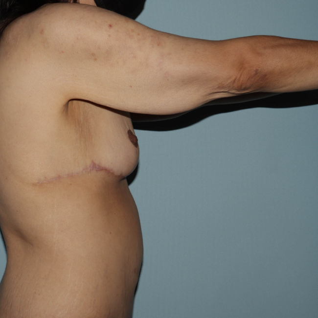 image before arm lift after weight loss - extended brachioplasty right arm view case 6600