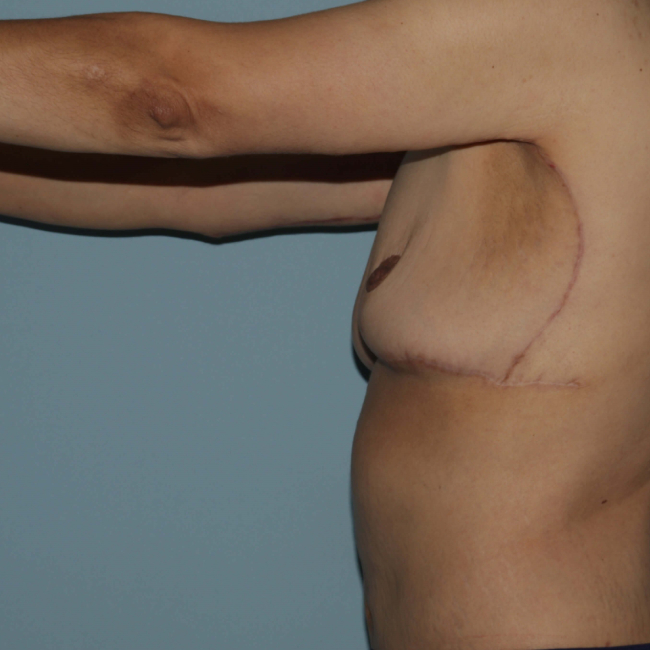 image after arm lift after weight loss - extended brachioplasty left arm view case 6600
