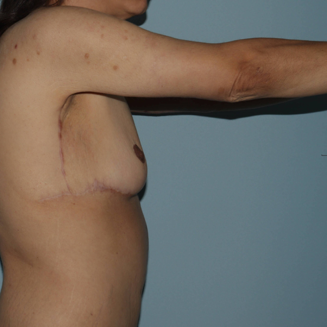 image after arm lift after weight loss - extended brachioplasty right arm view case 6600