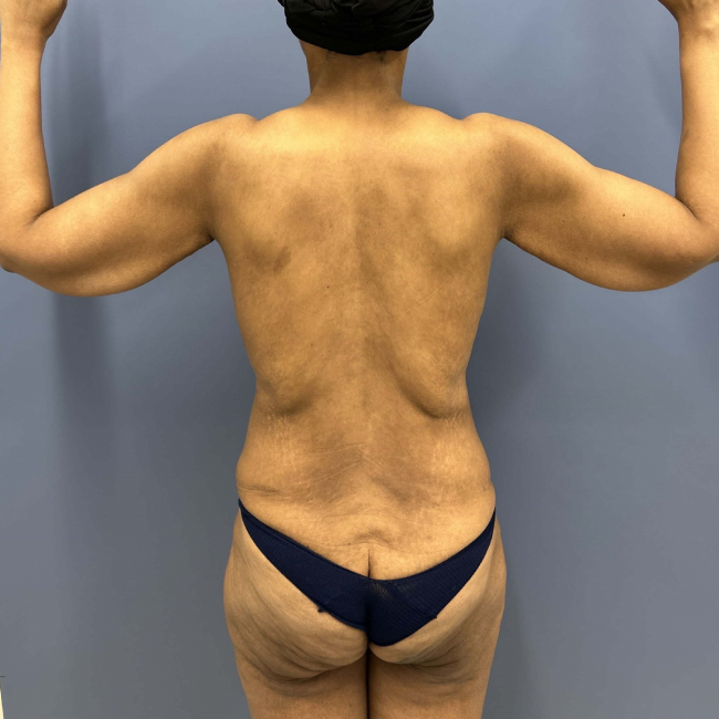 image before body lift and brachioplasty combo - back view case 6624