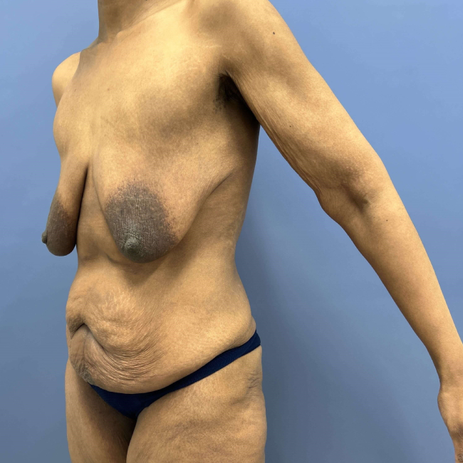 image before body lift and brachioplasty combo - left angle case 6624