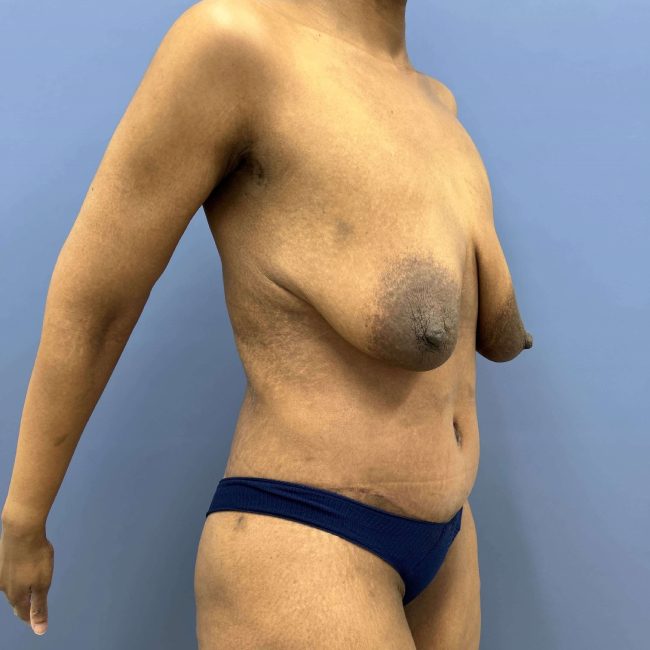 image after body lift and brachioplasty combo - right angle case 6624