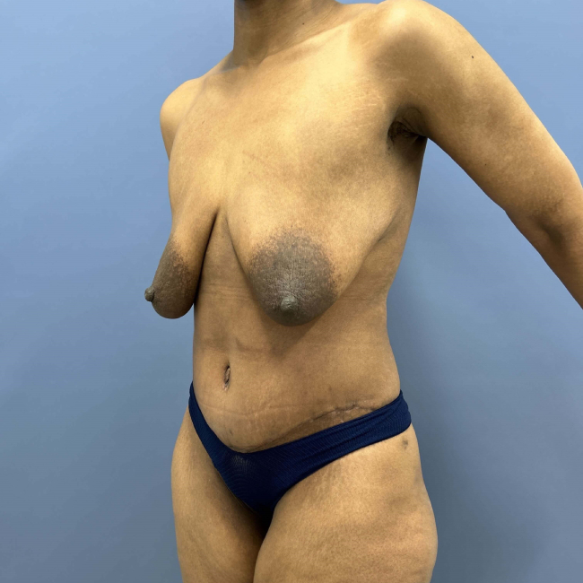 image after body lift and brachioplasty combo - left angle case 6624