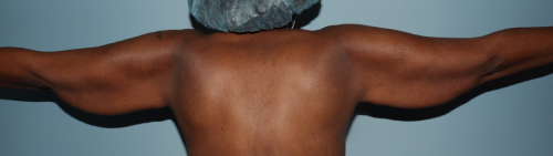 image before arm lift after body contouring - back view case 6662