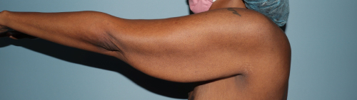 image before arm lift after body contouring - left arm view case 6662