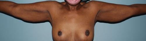 image before arm lift after body contouring - front view case 6662