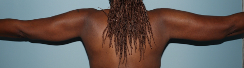image after arm lift after body contouring - back view case 6662
