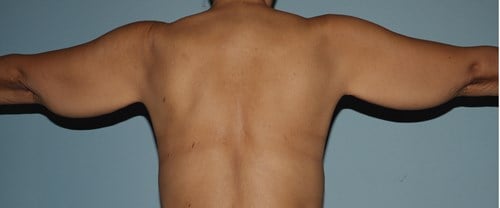 image before arm lift - scar location back view case 6670