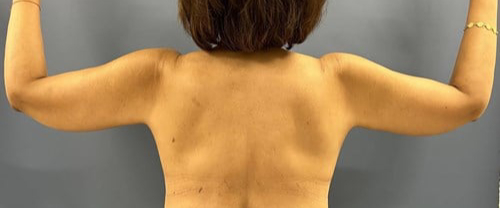 image after arm lift - scar location back view case 6670