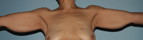 image before arm lift - scar location front view case 6670