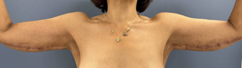 image after arm lift - scar location front view case 6670