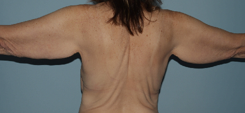 image before arm lift with breast lift - post bariatric back view case 6677