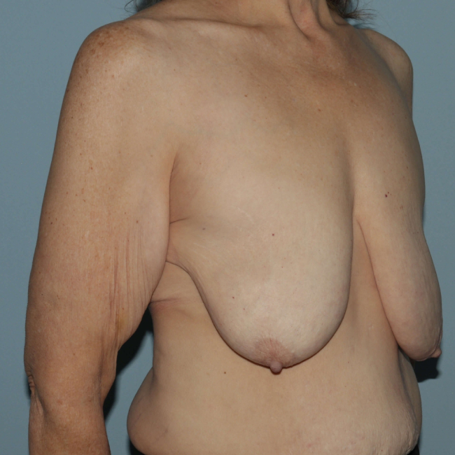 image before arm lift with breast lift - post bariatric right angle case 6677