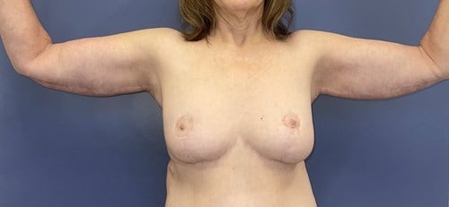 image after arm lift with breast lift - post bariatric front view case 6677