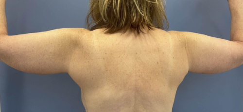 image after arm lift with breast lift - post bariatric back view case 6677