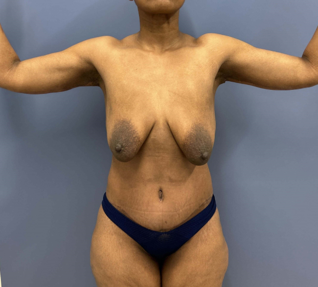 image after body lift and brachioplasty combo - front view case 6624