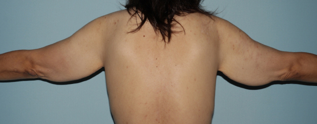image before arm lift after weight loss - extended brachioplasty back view case 6600