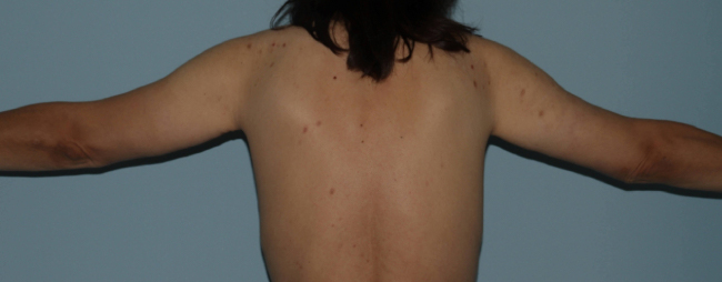 image after arm lift after weight loss - extended brachioplasty back view case 6600