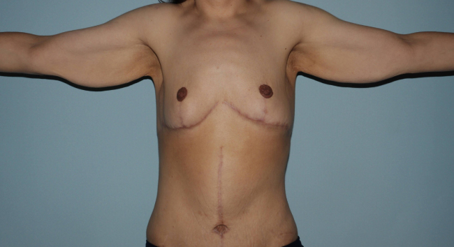image before arm lift after weight loss - extended brachioplasty front view case 6600