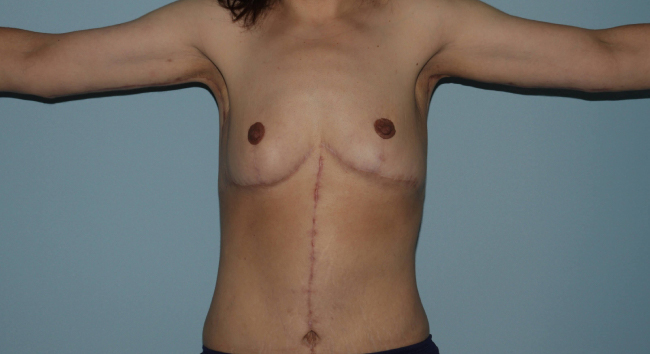 image after arm lift after weight loss - extended brachioplasty front view case 6600