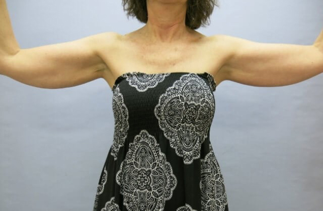 image before arm lift - batwing deformity front view case 6580