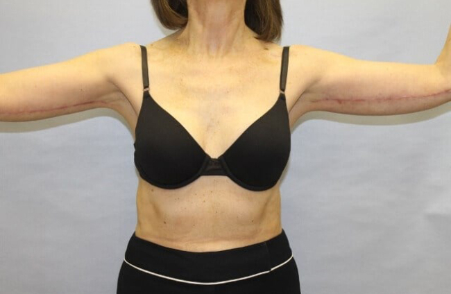 image after arm lift - batwing deformity front view case 6580