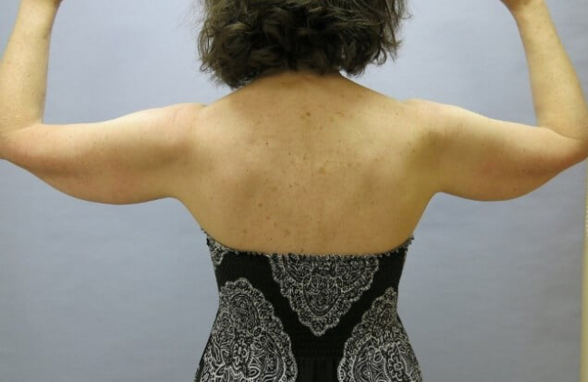 image before arm lift - batwing deformity back view case 6580